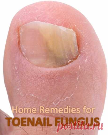 Home Remedies for Toenail Fungus | Virtual Clinic