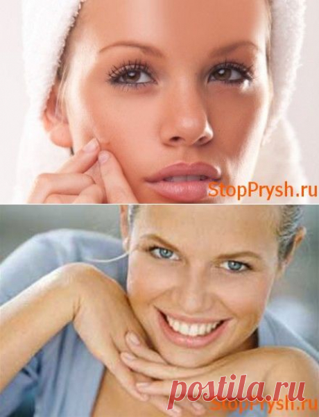 Как убрать подкожные прыщи на лице и теле: 8 способов