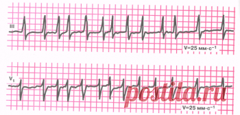 Мерцательная аритмия (фибрилляция предсердий) ЭКГ-признаки, причины, формы, лечение