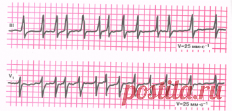 Мерцательная аритмия (фибрилляция предсердий) ЭКГ-признаки, причины, формы, лечение