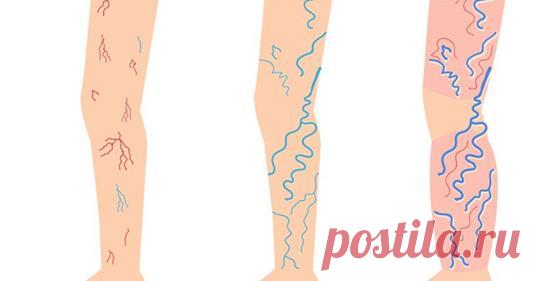 Используйте натуральный и простой рецепт, чтобы попрощаться с варикозными венами