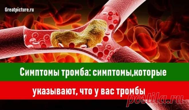 Симптомы тромба 
 Симптомы тромба: симптомы,которые указывают, что у вас тромбы.Информация, которую лучше запомнить! 💟.Это нужно знать.Сгустки крови, которые образуются в венах, могут быть очень опасными. Знание симп…
