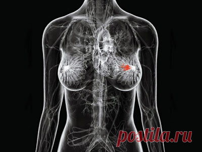 Основные причины рака груди, о которых вам стоит знать