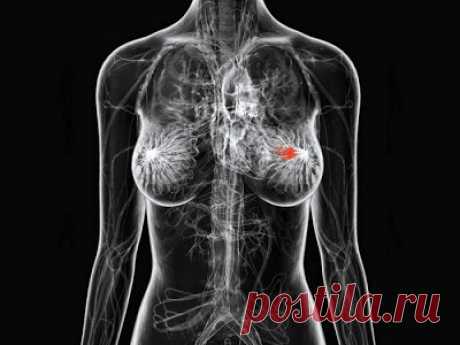 Основные причины рака груди, о которых вам стоит знать