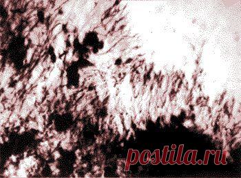 Актиномикоз, микоз ногтей, стоп. Свищ, актиномицеты, грибок, грибок стоп, грибок ногтей, гной, шелушение, инфильтрат, микоз кожи, онихомикоз ногтей, дерматомикоз, рубромикоз.