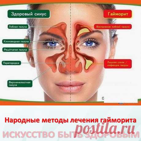 Народные методы лечения гайморита
Гайморит — воспаление слизистой оболочки, а иногда и костных стенок верхнечелюстной (гайморовой) пазухи. 
Причины возникновения гайморита. 
Гайморит часто сопровождается общей простудой, гриппом и другими инфекциями. Инфицирующие микробы, попадая в гайморовые пазухи, расположенные по обе стороны носовой перегородки, вызывают их воспаление. 
Проявления гайморита — боль в области пораженных (одной или обеих) пазух носа