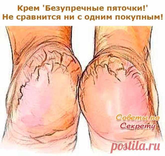Крем 'Безупречные пяточки!'...не сравнится ни с одним покупным! Поделюсь с вами рецептом крема для пяток, который не сравнится ни с одним покупным средством. И самое главное - сделать его легко и быстро. Нужно только купить в аптеке тюбик мази календулы (20г) и ампулку жидкого витамина А (10 мл), так будет легче дозировать, поскольку соотношение должно быть 1:2. В небольшой емкости хорошенько перемешайте витамин А и мазь. Вот собственно и все. Затем переложите готовый крем...
