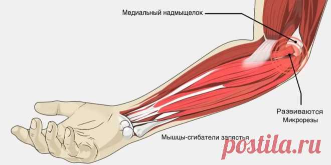 Локоть гольфиста. Триггерные точки