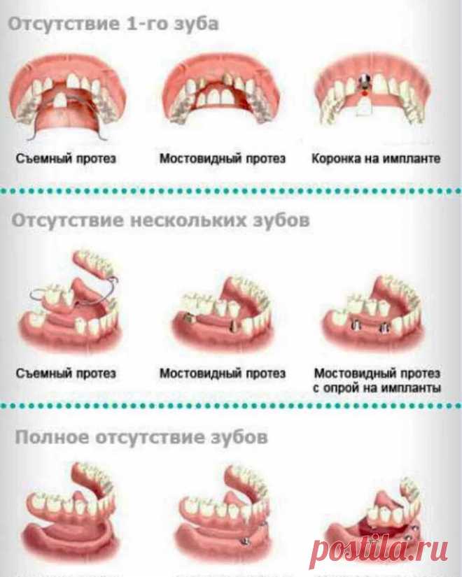 таблицы цен на съемные протезы из металлокерамики цена: 2 тыс изображений найдено в Яндекс Картинках