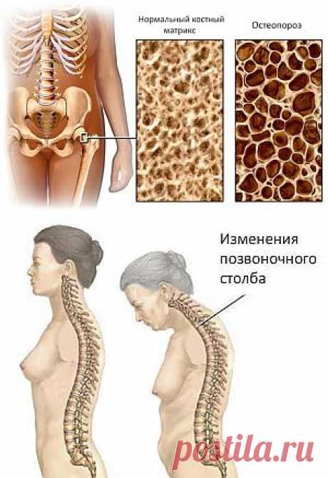 (+1) - Профилактика остеопороза | БУДЬ В ФОРМЕ!