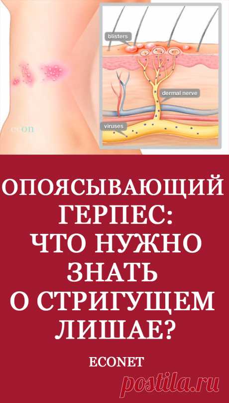 Опоясывающий герпес: что нужно знать о стригущем лишае?

Опоясывающим герпесом (лишаем) называют инфекционное заболевание, которое спровоцировано вирусом ветряной оспы. Главной областью поражения служат нервы под кожей, поэтому основным симптомом является возникновение вдоль нерва воспаления и сыпи (волдырей). Этому недугу подвержены в основном люди с ослабленным иммунитетом и в возрасте старше 50 лет. В подростковом возраст