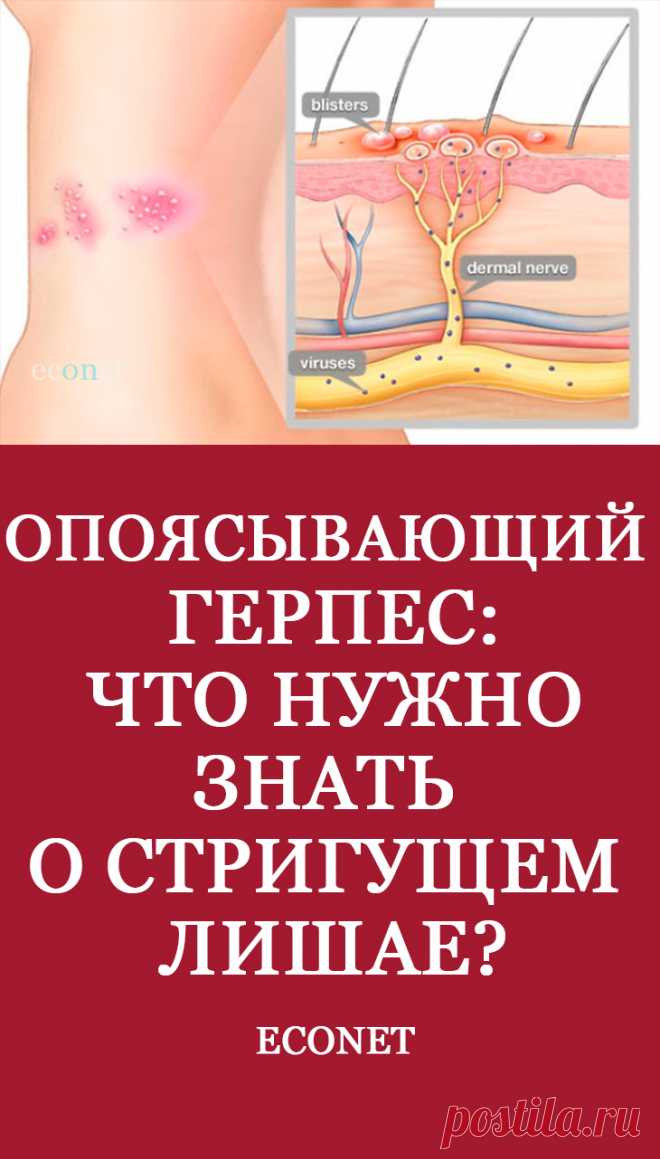 Опоясывающий герпес: что нужно знать о стригущем лишае?

Опоясывающим герпесом (лишаем) называют инфекционное заболевание, которое спровоцировано вирусом ветряной оспы. Главной областью поражения служат нервы под кожей, поэтому основным симптомом является возникновение вдоль нерва воспаления и сыпи (волдырей). Этому недугу подвержены в основном люди с ослабленным иммунитетом и в возрасте старше 50 лет. В подростковом возраст
