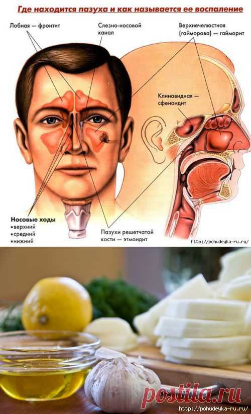 Лечим насморк дома с помощью простых народных средств!