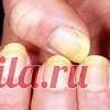 Грибок ногтей. Как избавиться?