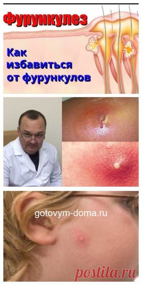 Мгновенная помощь от нарывов и фурункулов. Эта проблема не только наружная!