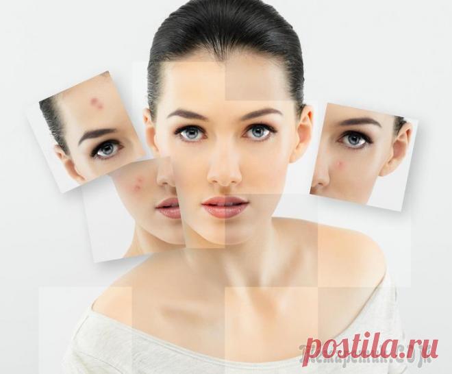 Псориаз: стадии, симптомы, признаки, причины. Лечение псориаза у детей и взрослых препаратами и народными средствами