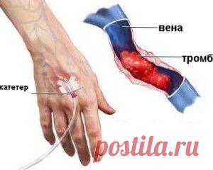 Средства и методы народной медицины в борьбе с тромбофлебитом | Домашний лекарь