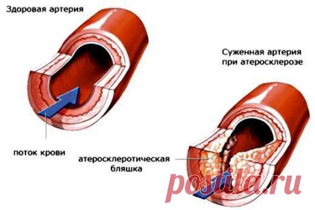 Лечение атеросклероза народными средствами.