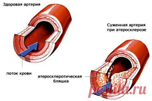 Лечение атеросклероза народными средствами.