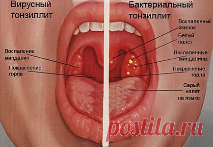Ангина. Описание, симптомы, виды и лечение ангины | Медицина на "Добро ЕСТЬ!"
