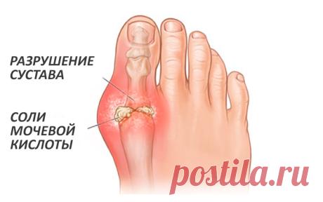 8 способов, как вылечить косточку на ноге Рост косточки в районе большого пальца стопы – довольно распространённая патология, которая доставляет неудобство многим женщинам.
