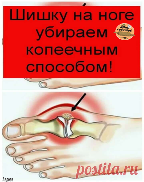 ШИШКУ НА НОГЕ УБИРАЕМ КОПЕЕЧНЫМ СПОСОБОМ!

Помню, как однажды на уроке биологии почувствовала себя по-настоящему ужасно. Мы изучали что-то связанное с генетикой, и учительница рассказывала нам о том, какие генетические заболевания передаются по наследству.

В качестве яркого примера она привела косточку на ноге. Увеличенная косточка, некрасивая и болезненная, как подробно расписывала преподавательница, передается по наследству по женской линии. Если у вашей мамы или бабушк...