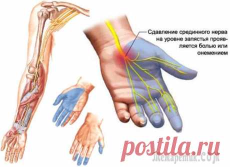 Туннельный синдром запястья— профилактика и лечение