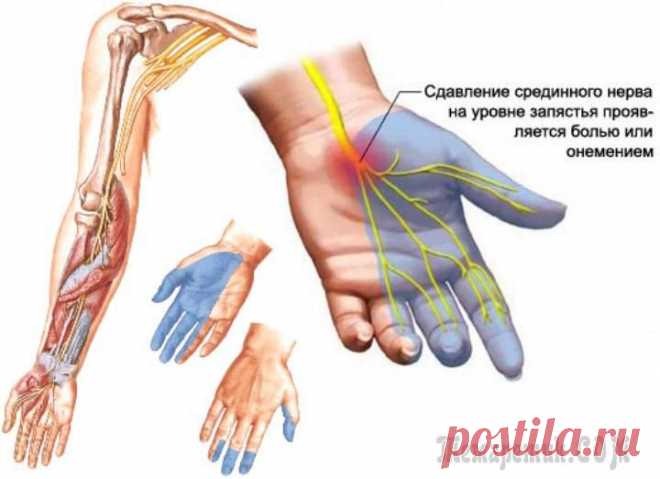 Туннельный синдром запястья— профилактика и лечение