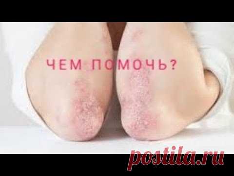 Псориаз. Аюрведические рецепты из куркумы от псориаза, экземы и дерматита. Мазь и напиток.