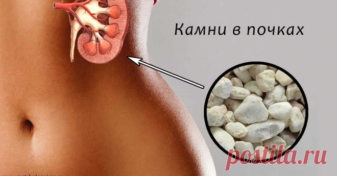 Камни в почках — рецепты, которые помогут избежать операции. Просто и доступно, главное — не лениться!