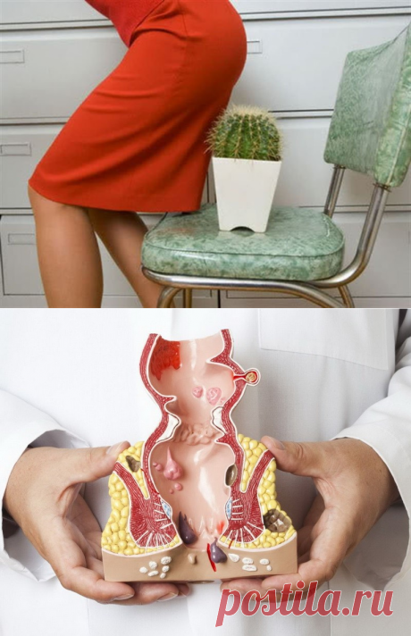 Истории и факты о геморрое