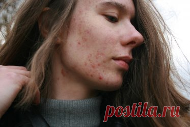 Что такое карта прыщей и можно ли ей верить?. Правда ли, что если прыщики вскакивают на лбу, то дело в кишечнике? Что такое карта прыщей и стоит ли ей верить?