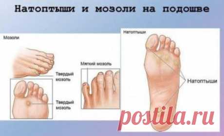 Натуральные средства для удаления мозолей и натоптышей Несмотря на то, что мозоли и волдыри на коже – это явления разные, средства для избавления от них очень похожи…