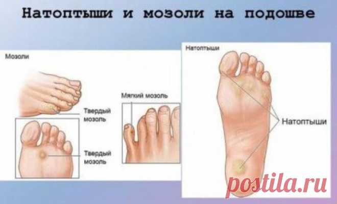 Натуральные средства для удаления мозолей и натоптышей Несмотря на то, что мозоли и волдыри на коже – это явления разные, средства для избавления от них очень похожи…