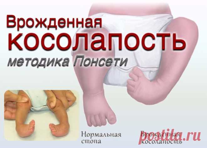 Врожденная косолапость является сложным пороком развития, при котором изменение внешней формы стопы является проявлением патологии костной, суставной, нервной и сосудистой системы нижней конечности.