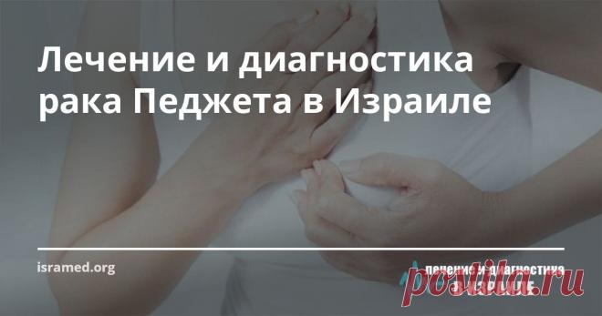 Лечение и диагностика рака Педжета в Израиле Как результат, эффективность лечения рака Педжета в нашем центре приближается к 95%, причем наши онкологи и онкохирурги стараются удалить опухоль при сохранении груди и минимизации риска рецидива.