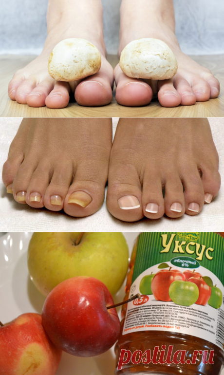 Почему врачи молчат? Смесь, от которой исчезает грибок на ногах и руках.