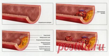АТЕРОСКЛЕРОЗ НИЖНИХ КОНЕЧНОСТЕЙ И ПРАВИЛА ЗОЖ