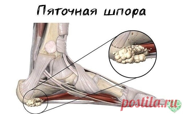 Пеленание от шпор