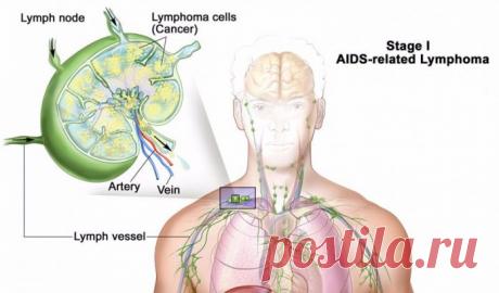 Это важно! Не давайте лимфе застаиваться!