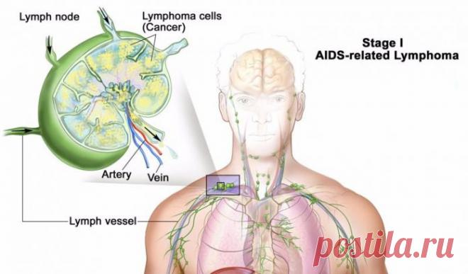 Это важно! Не давайте лимфе застаиваться!