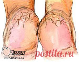 Бабушкины рецепты от трещин на пятках | Женский мир