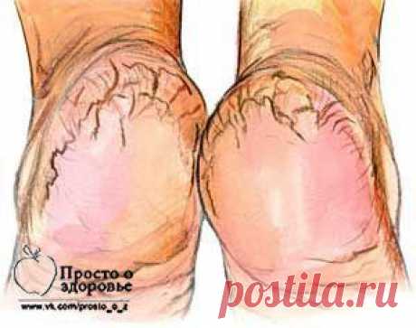 Бабушкины рецепты от трещин на пятках | Женский мир
