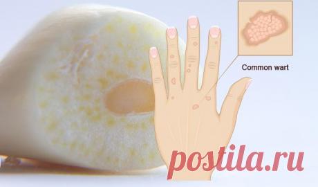 Как удалить родинки, бородавки, угри, кожные теги и возрастные пятна совершенно естественным методом! - Интересный блог Эффективные методы! Будучи самым большим органом в организме человека, кожа действует как барьер, защищая организм от вредной окружающей среды. Тем не