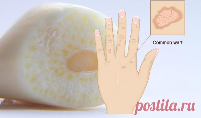 Как удалить родинки, бородавки, угри, кожные теги и возрастные пятна совершенно естественным методом! - Интересный блог Эффективные методы! Будучи самым большим органом в организме человека, кожа действует как барьер, защищая организм от вредной окружающей среды. Тем не