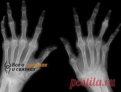 Ревматоидный полиартрит: лечение, симптомы и причины