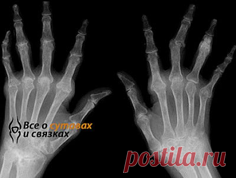 Ревматоидный полиартрит: лечение, симптомы и причины