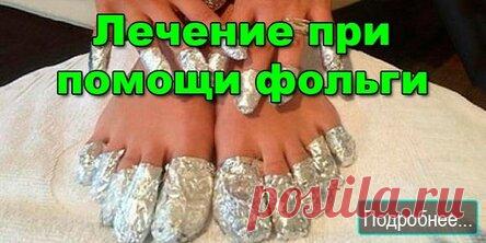 Лечение при помощи столовой фольги.