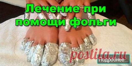 Лечение при помощи столовой фольги.