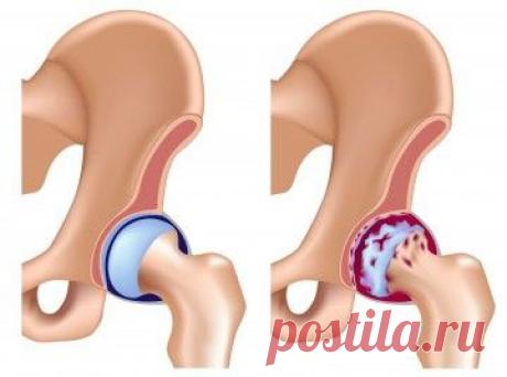 Как лечить коксартроз тазобедренного сустава народными средствами, рекомендации по питанию и др